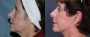 Dr. Grzeskiewicz Facelift Patient 2