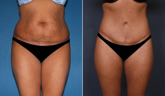566167AbdominoplastyJLG copy