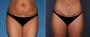 Dr. Grzeskiewicz Tummy Tuck Patient 2
