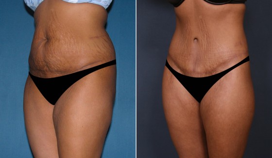 566167AbdominoplastyJLG2 copy