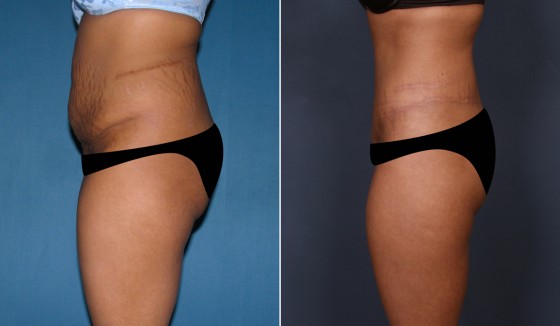 566167AbdominoplastyJLG3 copy