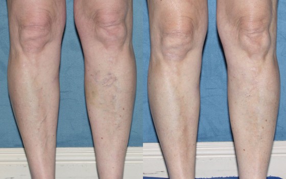 566253LegVein