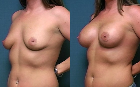 566439BreastAug-HMR-1-2