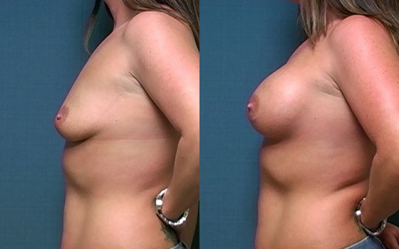 566439BreastAug-HMR-1-3