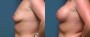Dr. Roark Breast Augmentation Patient 5