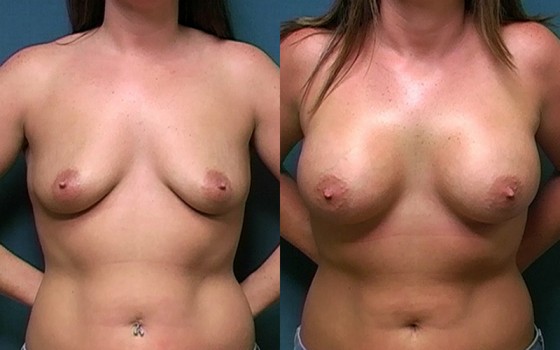 566439BreastAug-HMR-1