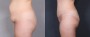 Dr. Roark Tummy Tuck Patient 1
