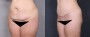 Dr. Roark Tummy Tuck Patient 2