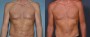 Dr. Grzeskiewicz Tummy Tuck Patient 5