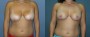 Dr. Grzeskiewicz Breast Lift Patient 5