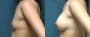 Dr. Roark Breast Augmentation Patient 6