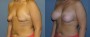 Dr. Grzeskiewicz Breast Lift Patient 4