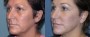 Dr. Grzeskiewicz Facelift Patient 3