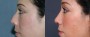 Dr. Grzeskiewicz Rhinoplasty Patient 3