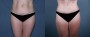 Dr. Grzeskiewicz Tummy Tuck Patient 8