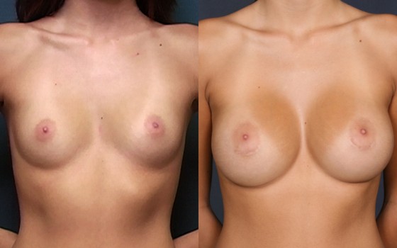 570424Breast Aug-HMR