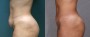 Dr. Roark Tummy Tuck Patient 5