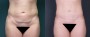 Dr. Roark Tummy Tuck Patient 6