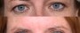 Dr. Saltz Eyelid Lift Patient 3