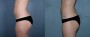 Dr. Grzeskiewicz Liposuction Patient 3