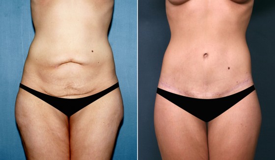 573930AbdominoplastyJLG copy