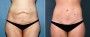 Dr. Grzeskiewicz Tummy Tuck Patient 1