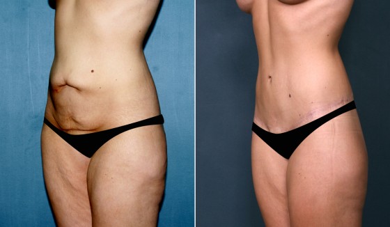 573930AbdominoplastyJLG2 copy