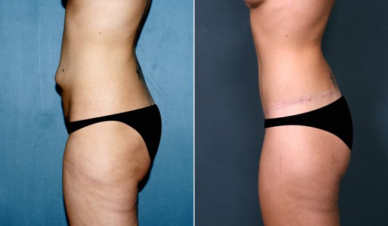 573930AbdominoplastyJLG3 copy
