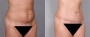 Dr. Roark Tummy Tuck Patient 8