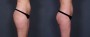 Dr. Saltz Liposuction Patient 2