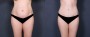 Dr. Brahme Tummy Tuck Patient 9