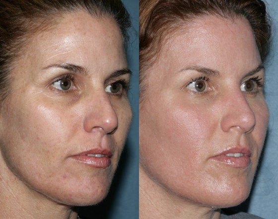 576556RepairAlexBotox1-2