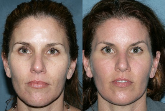 576556RepairAlexBotox1