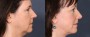 Dr. Roark Facelift Patient 6