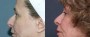 Dr. Grzeskiewicz Rhinoplasty Patient 4