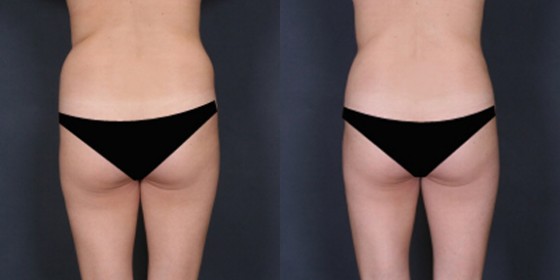 577281LHSLipo