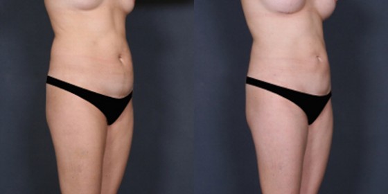 577281LHSLipo3