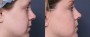 Dr. Roark Neck Liposuction Patient 2