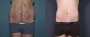 Dr. Grzeskiewicz Tummy Tuck Patient 6