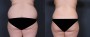Dr. Brahme Liposuction Patient 2