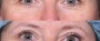 Dr. Saltz Eyelid Lift Patient 2
