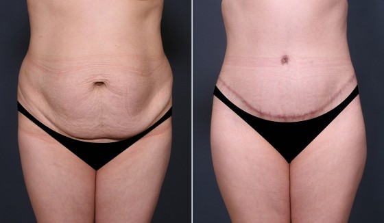 579968AbdominoplastyJLG copy