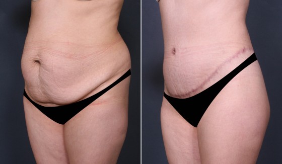 579968AbdominoplastyJLG2 copy