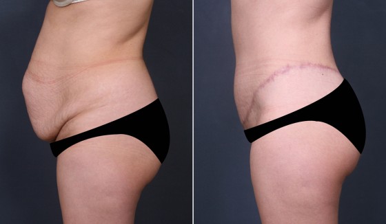 579968AbdominoplastyJLG3 copy