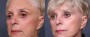 Dr. Brahme Facelift Patient 9