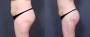 Dr. Saltz Liposuction Patient 4