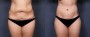 Dr. Brahme Tummy Tuck Patient 8