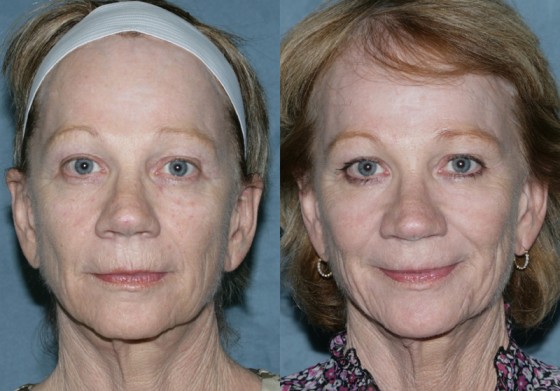 581259AlexRePairErbium1