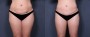 Dr. Grzeskiewicz Tummy Tuck Patient 10