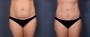 Dr. Saltz Tummy Tuck Patient 11